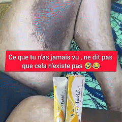 Fevicid Crème – Antimycose, Taches Noires et Boutons de Rasage