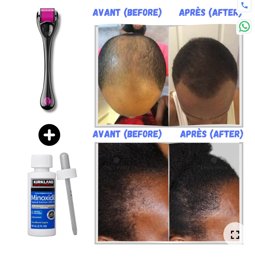 Minoxidil 5 % – Traitement antichute et repousse des cheveux