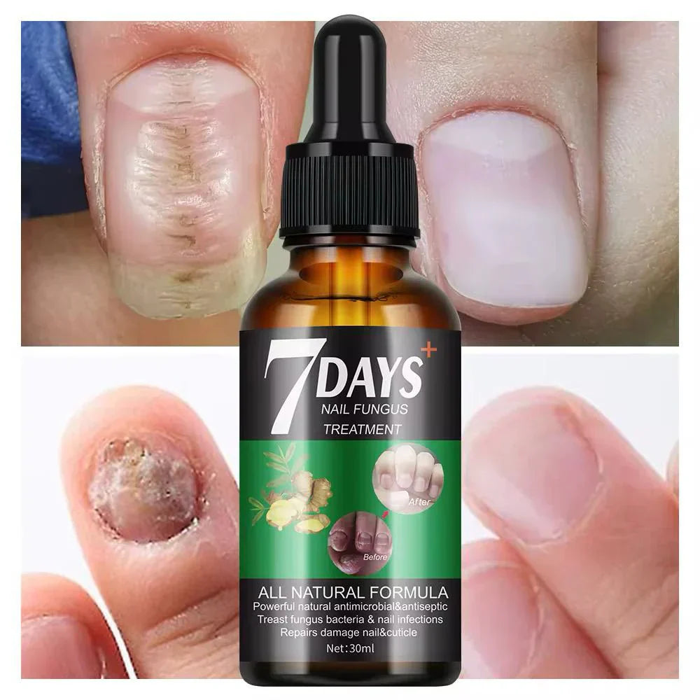 Traitement anti-mycoses des ongles