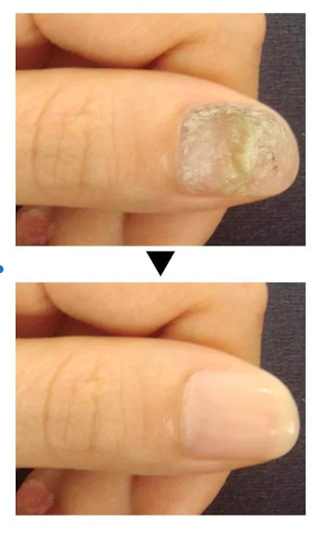 Traitement anti-mycoses des ongles