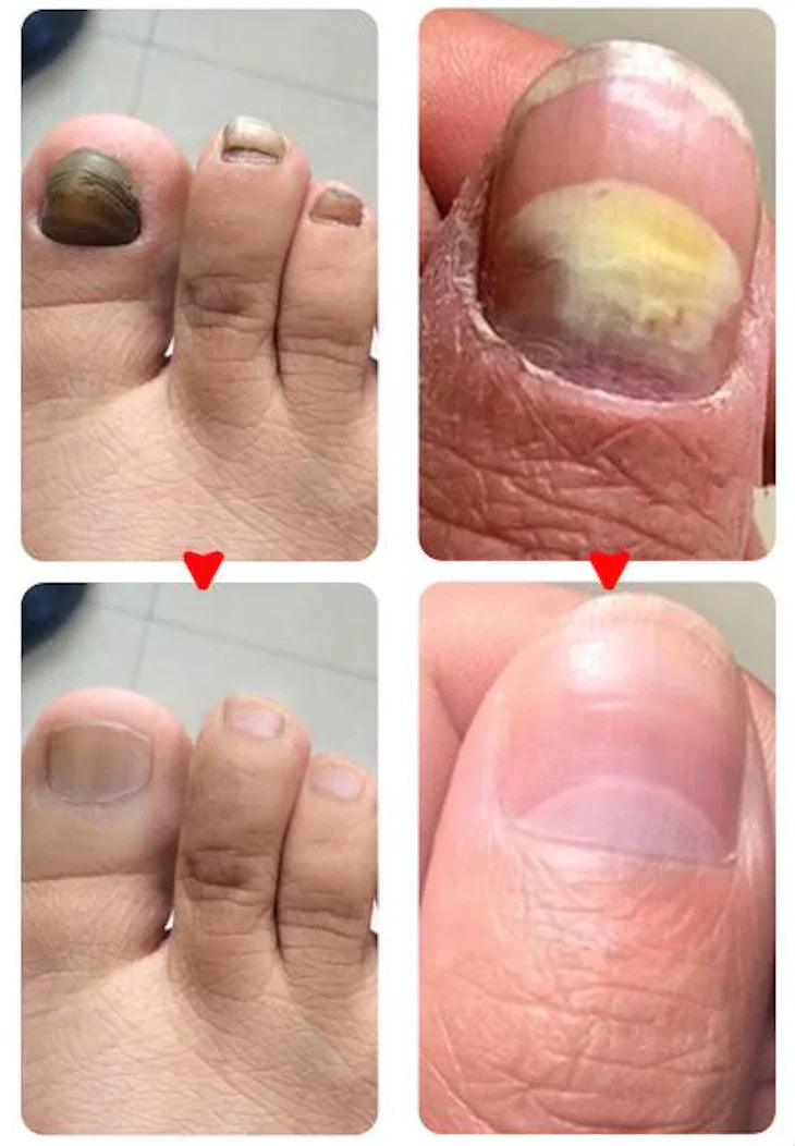 Traitement anti-mycoses des ongles