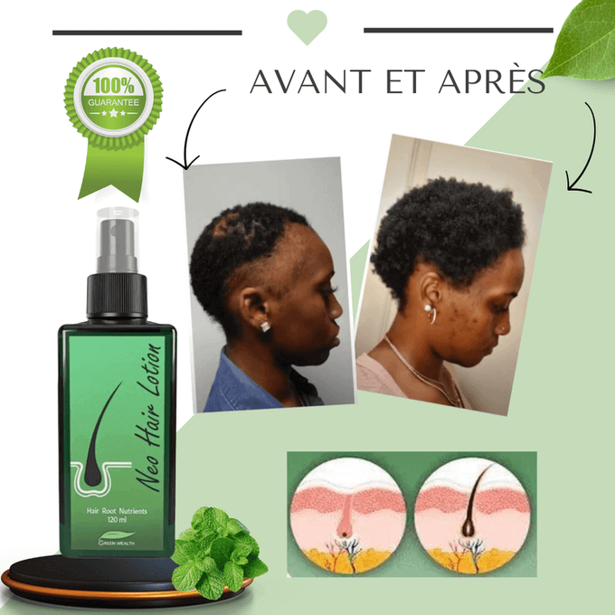 Say Goodbye to Thinning Hair and Bald Patches